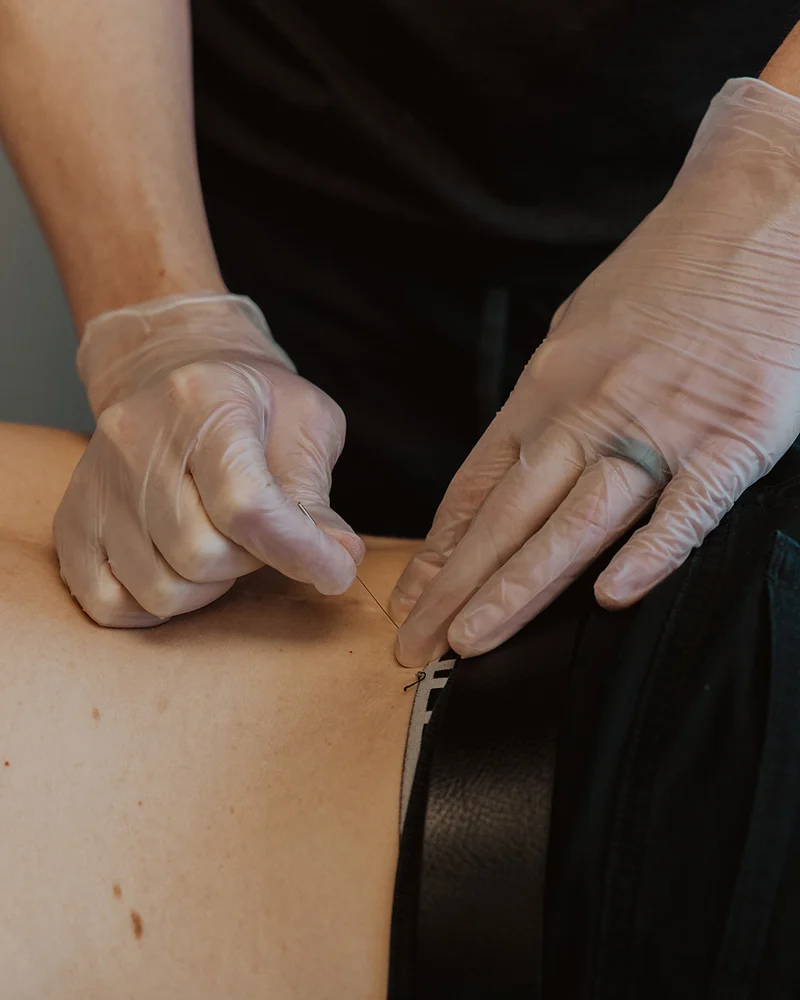 Physiotherapist inserting dry needle into patient's lower back muscle during dry needling treatment in Kelowna