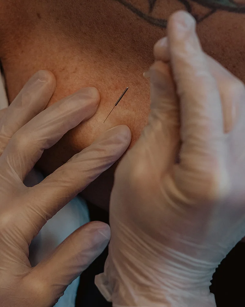 Close-up of dry needle inserted into upper trapezius trigger point during physiotherapy treatment in Kelowna
