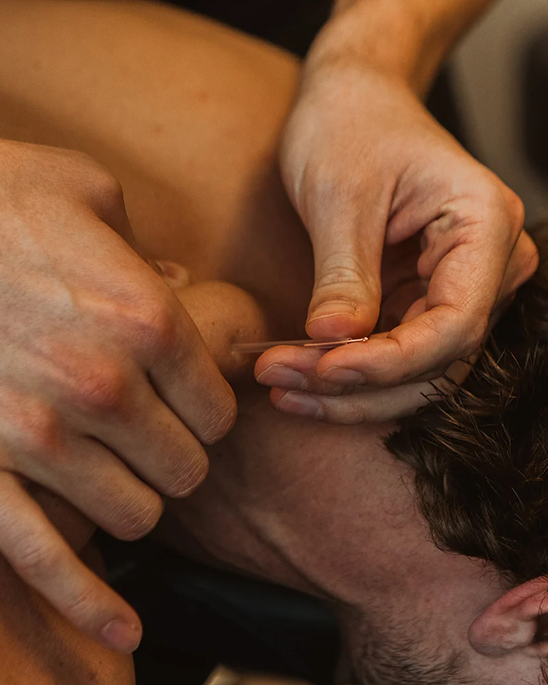 Practitioner inserting dry needle into suboccipital neck muscle for headache and tension relief in Kelowna