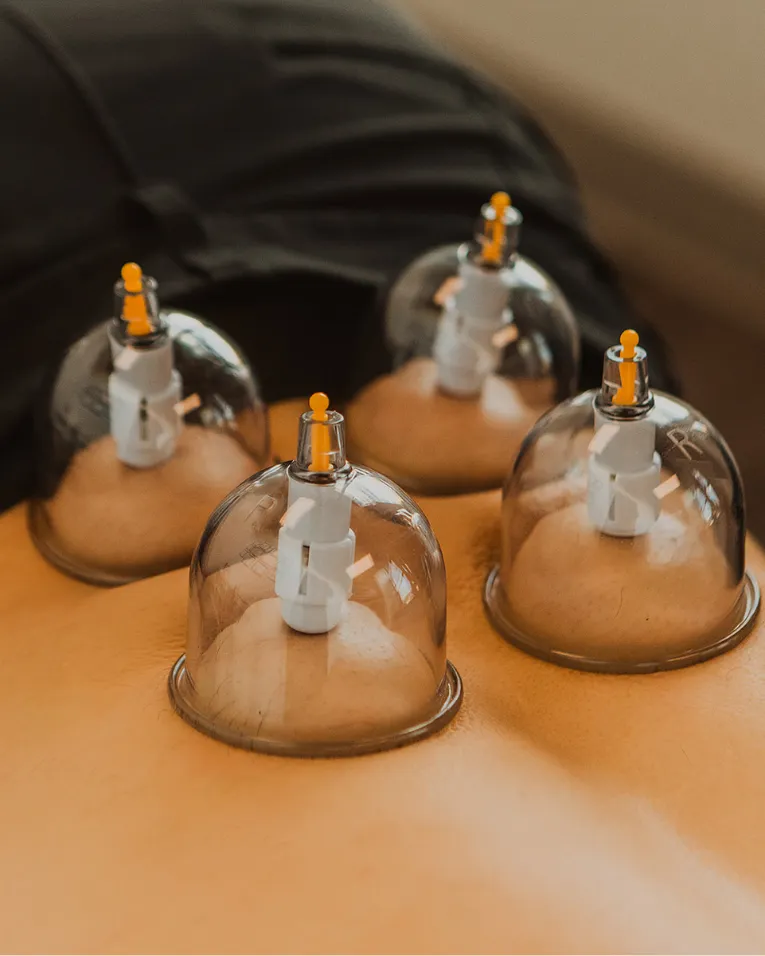 Cupping therapy treatment used for muscle tension relief and recovery in Kelowna clinic