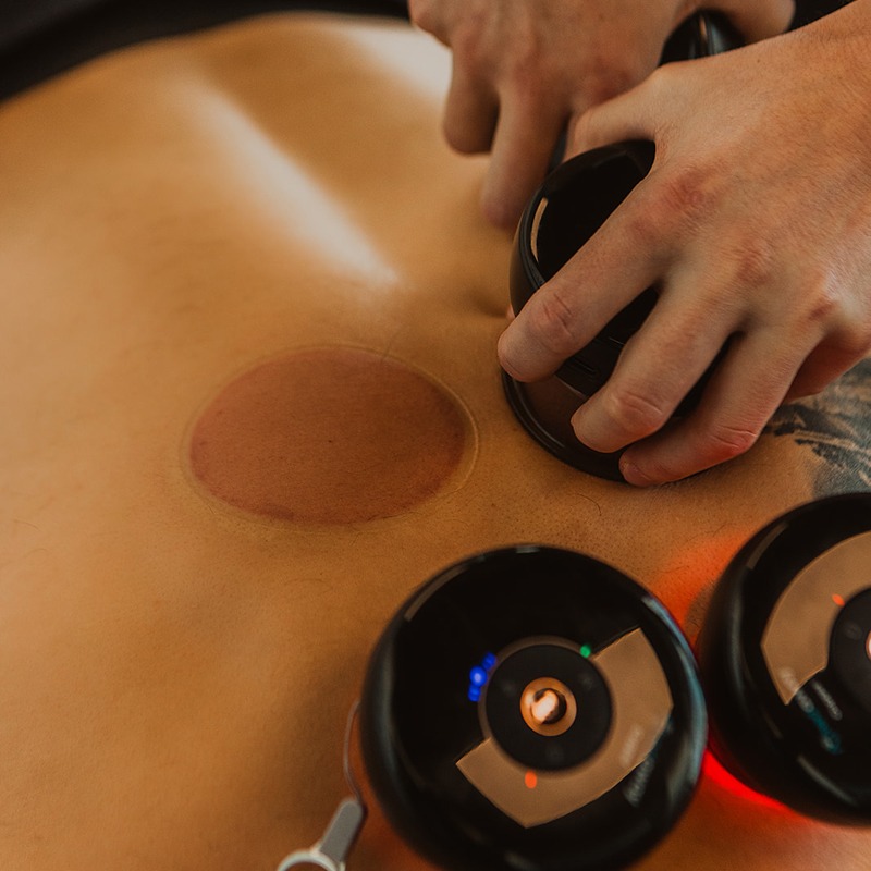 Close-up of cupping therapy applied to back muscles for recovery and soft tissue release