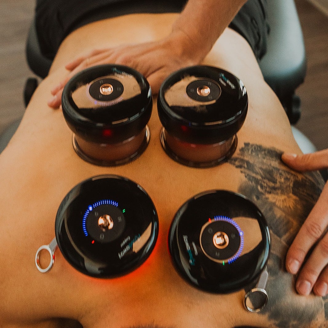 Multiple cupping therapy devices applied to back for pain relief and circulation improvement