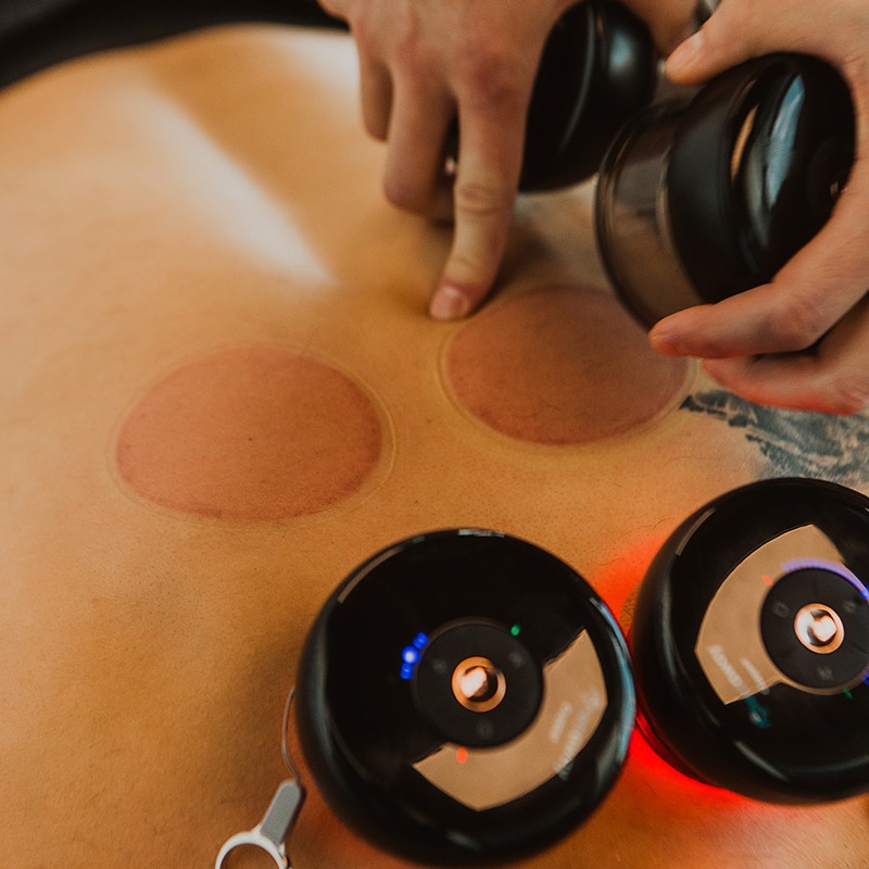 Cupping therapy session showing circular marks on back after muscle tension treatment